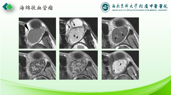 影像PPT - 【PPT】眼部常见疾病影像学定位诊断-11