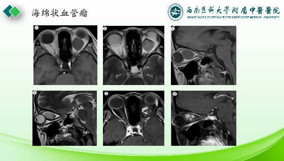 影像PPT - 【PPT】眼部常见疾病影像学定位诊断-10