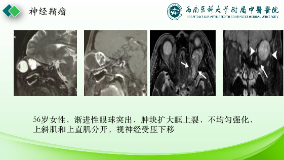 影像PPT - 【PPT】眼部常见疾病影像学定位诊断-22