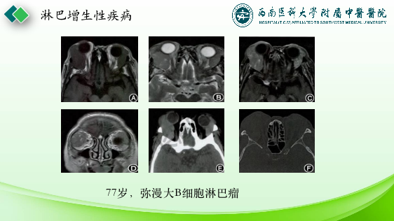 影像PPT - 【PPT】眼部常见疾病影像学定位诊断-25