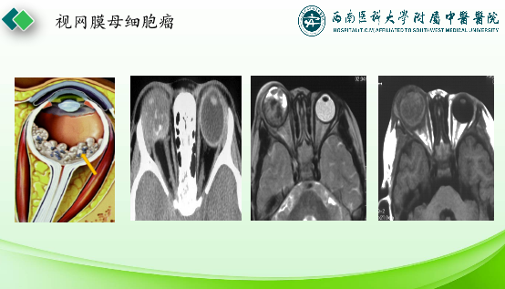 影像PPT - 【PPT】眼部常见疾病影像学定位诊断-38