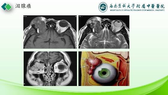 影像PPT - 【PPT】眼部常见疾病影像学定位诊断-34