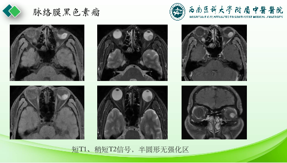 影像PPT - 【PPT】眼部常见疾病影像学定位诊断-41