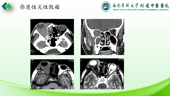 影像PPT - 【PPT】眼部常见疾病影像学定位诊断-44