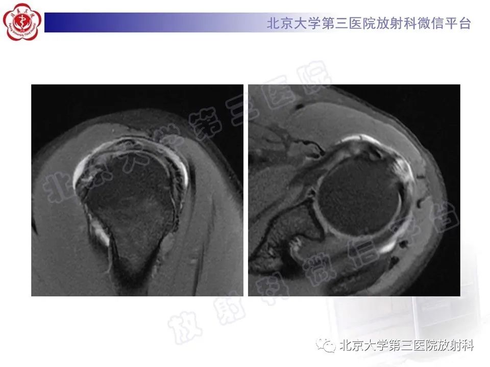 影像PPT - 【PPT】肩胛下肌腱断裂-4