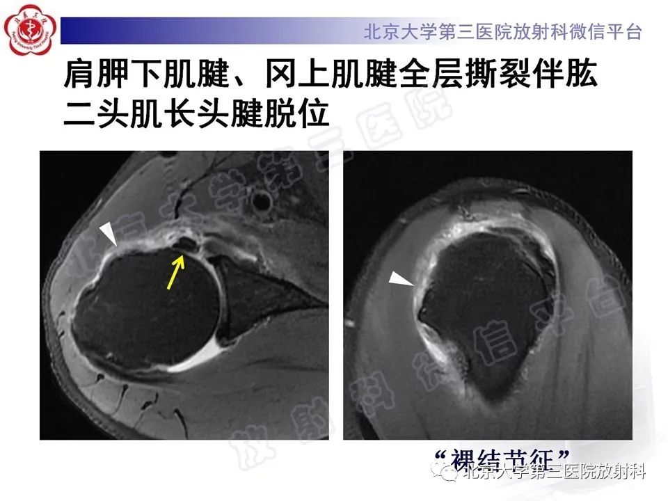 影像PPT - 【PPT】肩胛下肌腱断裂-15