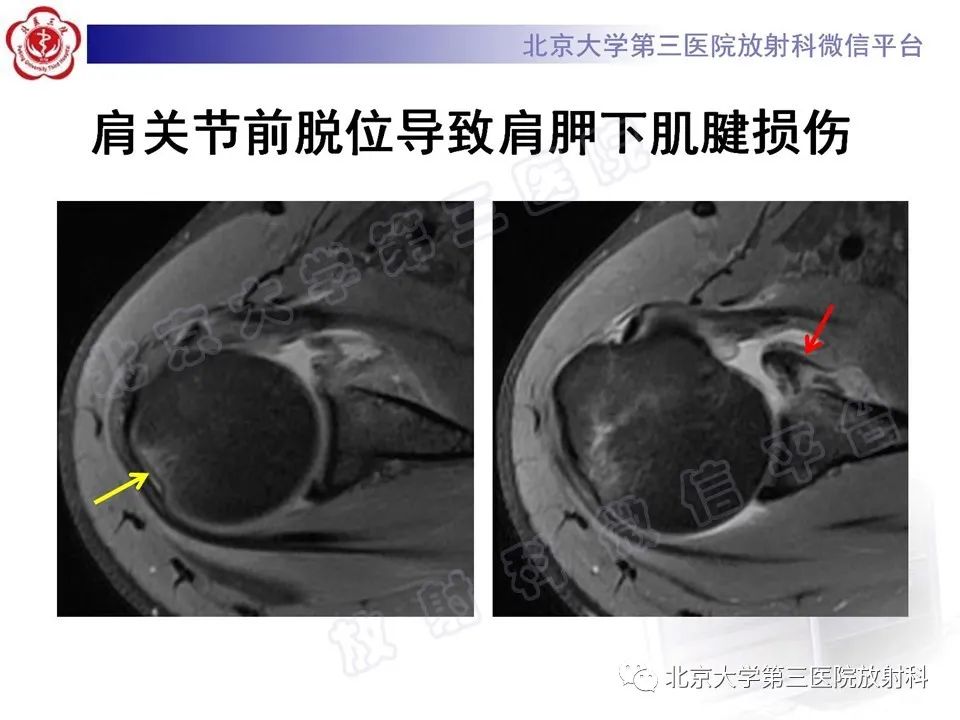 影像PPT - 【PPT】肩胛下肌腱断裂-17