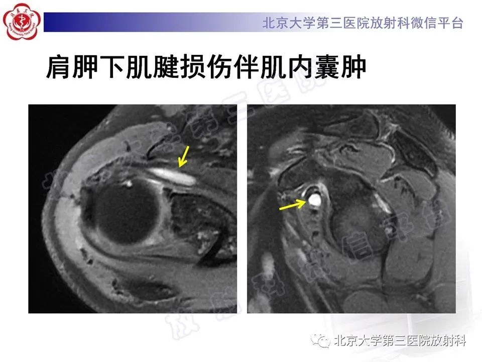影像PPT - 【PPT】肩胛下肌腱断裂-18