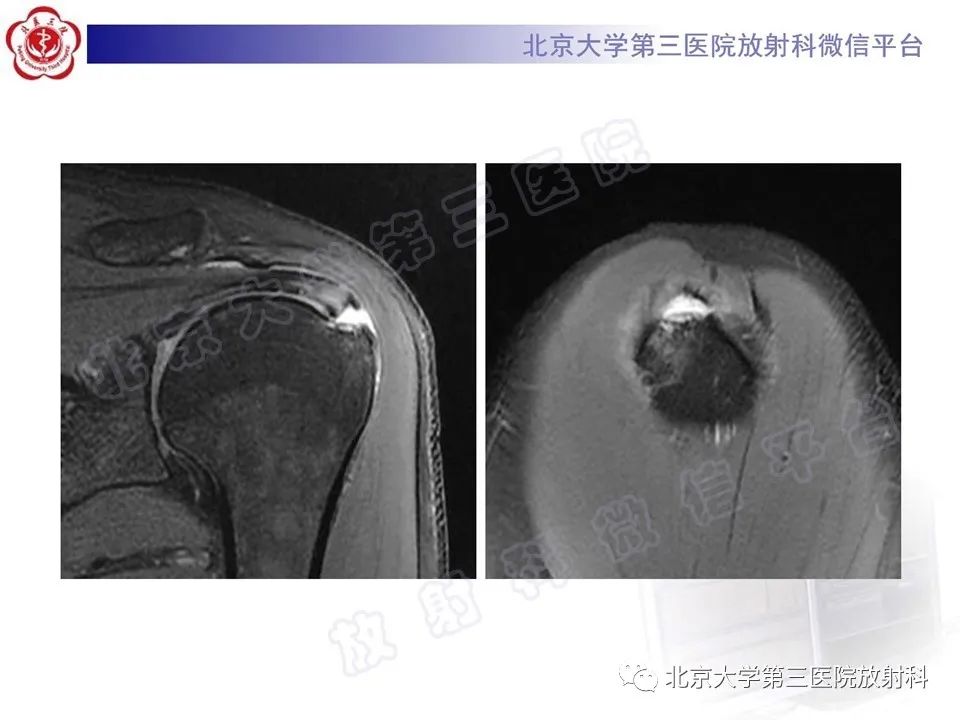 影像PPT - 【PPT】肩胛下肌腱断裂-3
