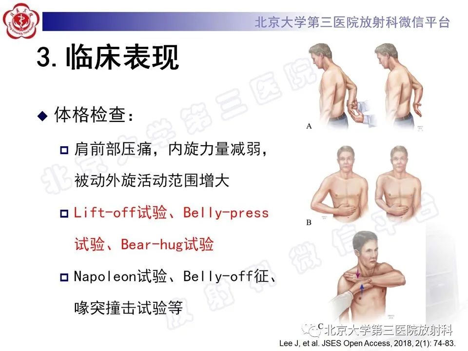 影像PPT - 【PPT】肩胛下肌腱断裂-11