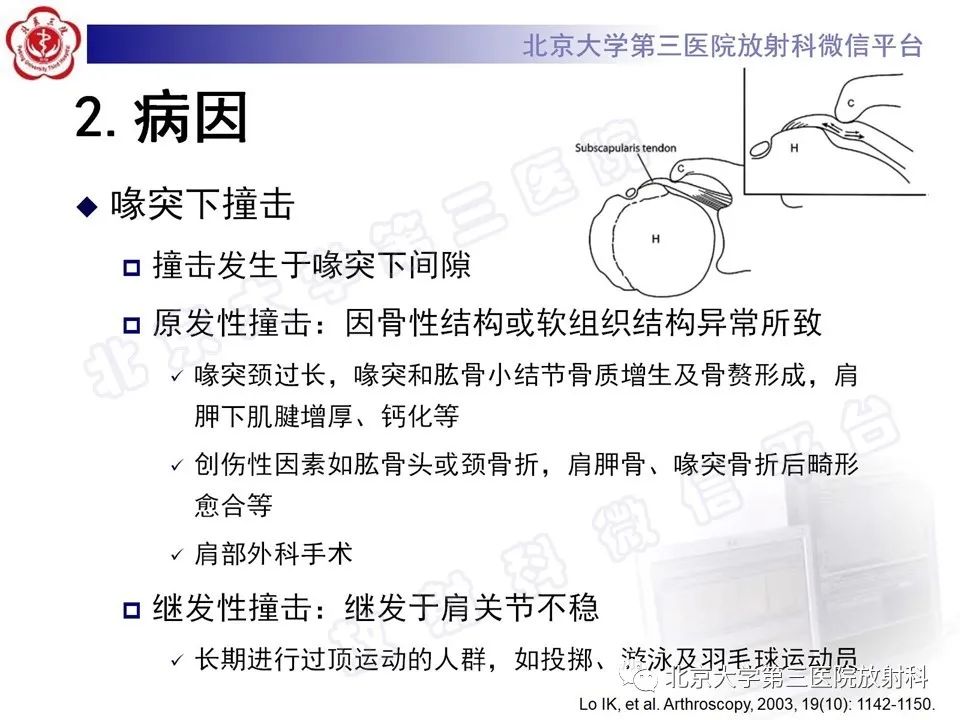 影像PPT - 【PPT】肩胛下肌腱断裂-9