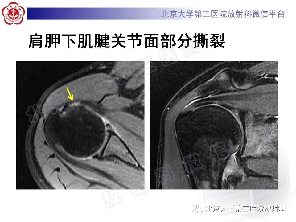 影像PPT - 【PPT】肩胛下肌腱断裂-14