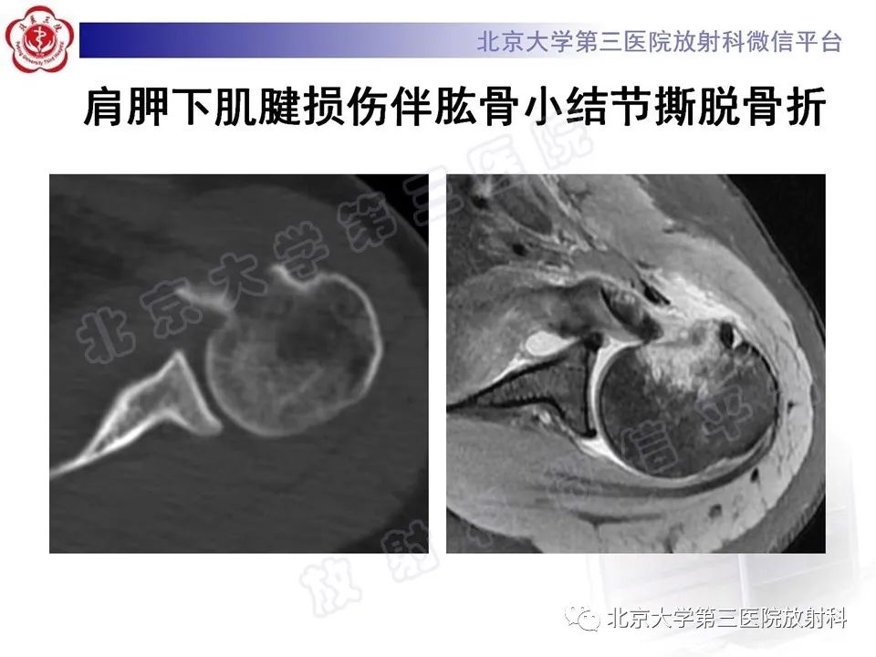 影像PPT - 【PPT】肩胛下肌腱断裂-16