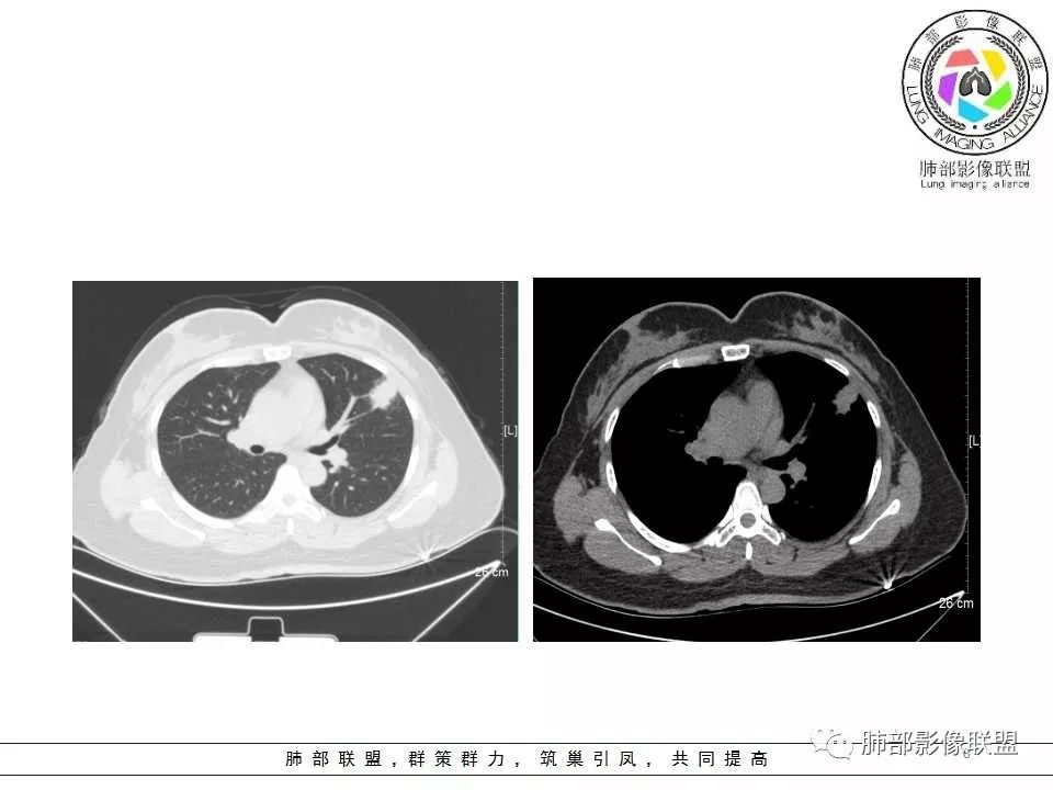 影像PPT - 【病例】肺隐球菌病1例CT影像-8 影像PPT - 【病例】肺隐球菌病1例CT影像-8