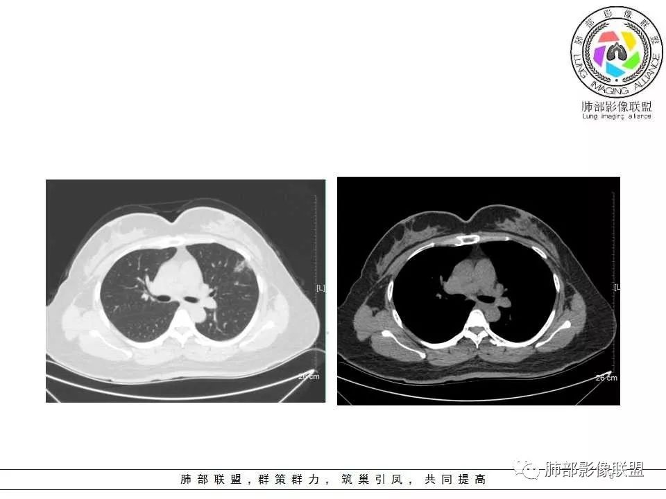 影像PPT - 【病例】肺隐球菌病1例CT影像-6 影像PPT - 【病例】肺隐球菌病1例CT影像-6