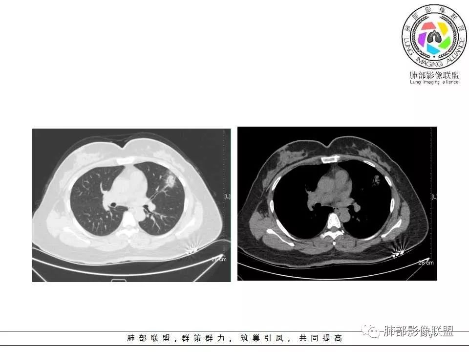 影像PPT - 【病例】肺隐球菌病1例CT影像-9 影像PPT - 【病例】肺隐球菌病1例CT影像-9