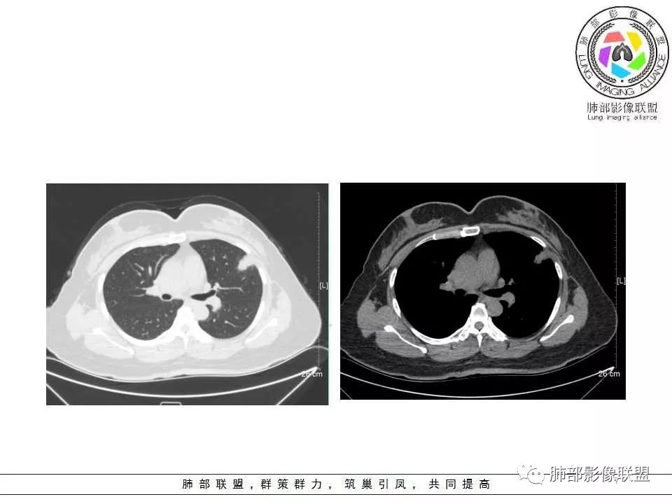 影像PPT - 【病例】肺隐球菌病1例CT影像-7 影像PPT - 【病例】肺隐球菌病1例CT影像-7