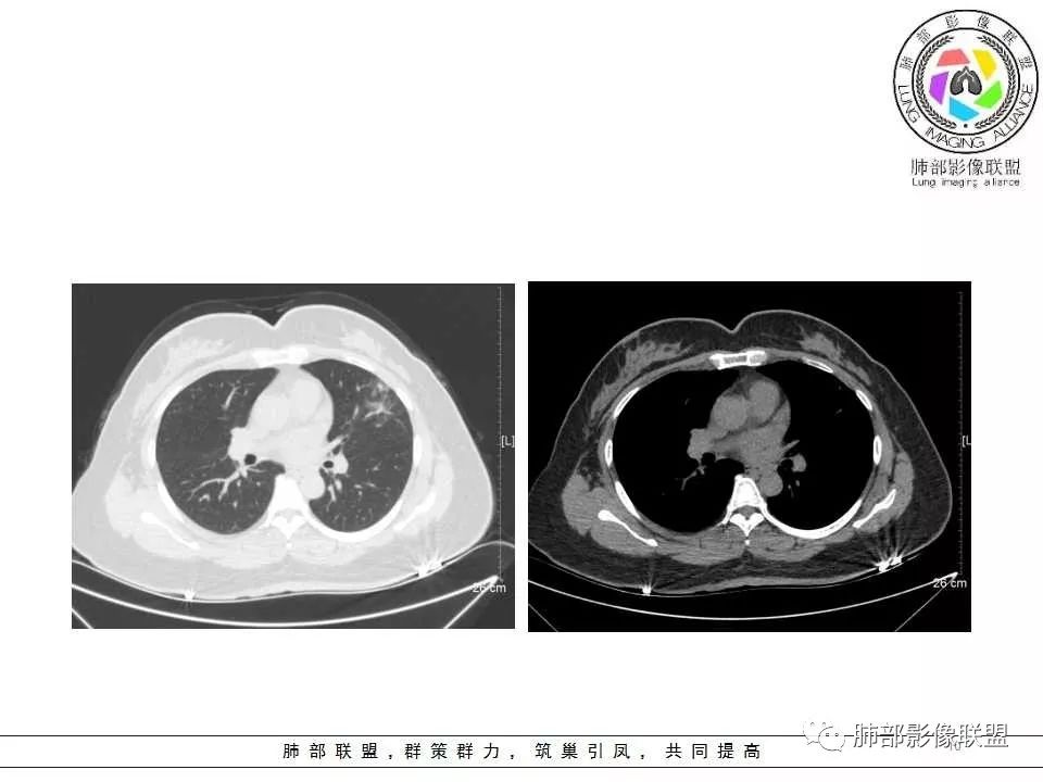 影像PPT - 【病例】肺隐球菌病1例CT影像-10 影像PPT - 【病例】肺隐球菌病1例CT影像-10