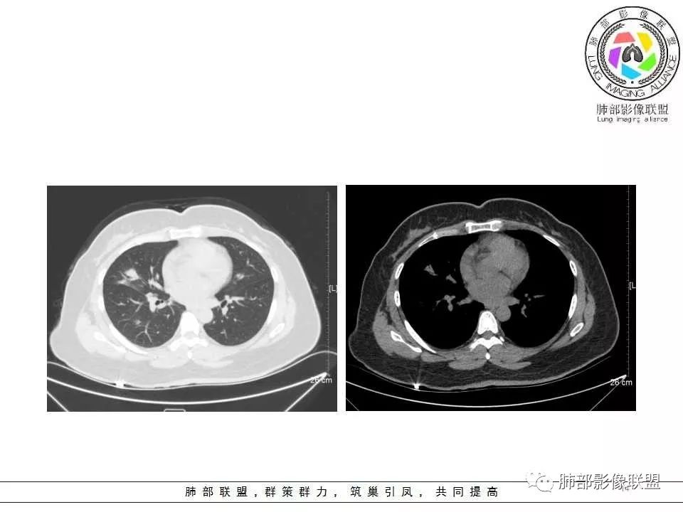 影像PPT - 【病例】肺隐球菌病1例CT影像-14 影像PPT - 【病例】肺隐球菌病1例CT影像-14