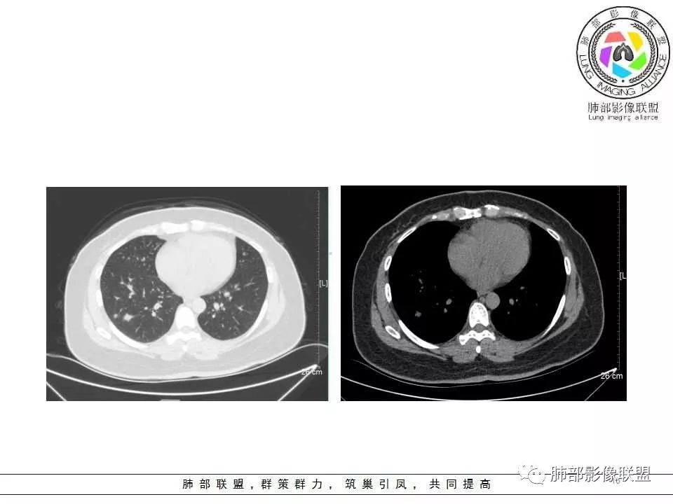 影像PPT - 【病例】肺隐球菌病1例CT影像-16 影像PPT - 【病例】肺隐球菌病1例CT影像-16