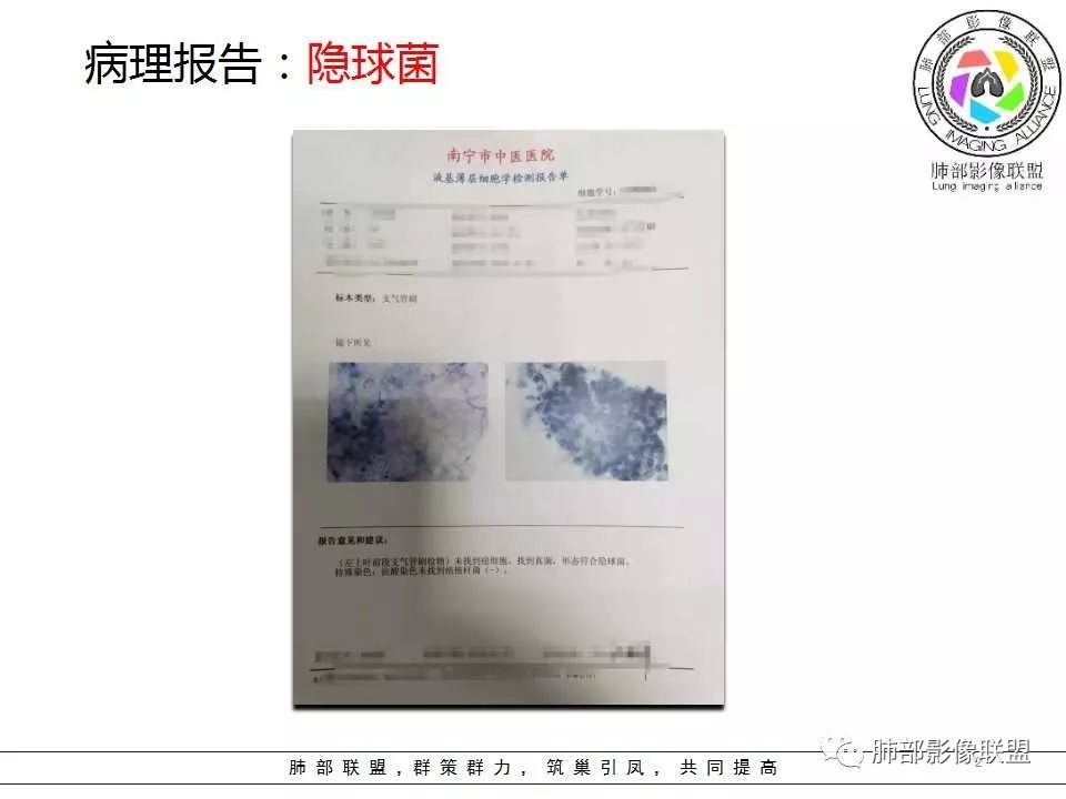影像PPT - 【病例】肺隐球菌病1例CT影像-19 影像PPT - 【病例】肺隐球菌病1例CT影像-19