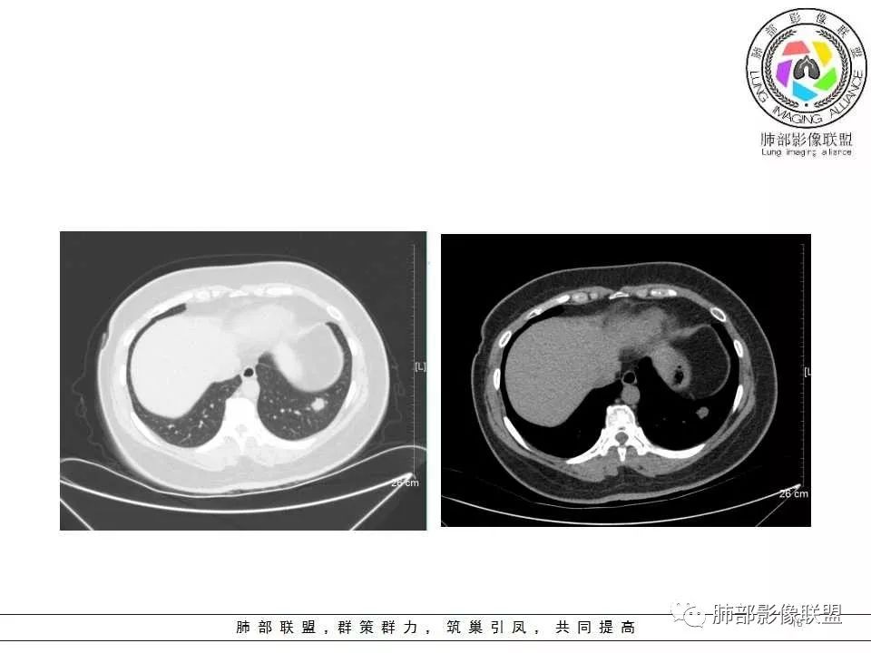 影像PPT - 【病例】肺隐球菌病1例CT影像-18 影像PPT - 【病例】肺隐球菌病1例CT影像-18