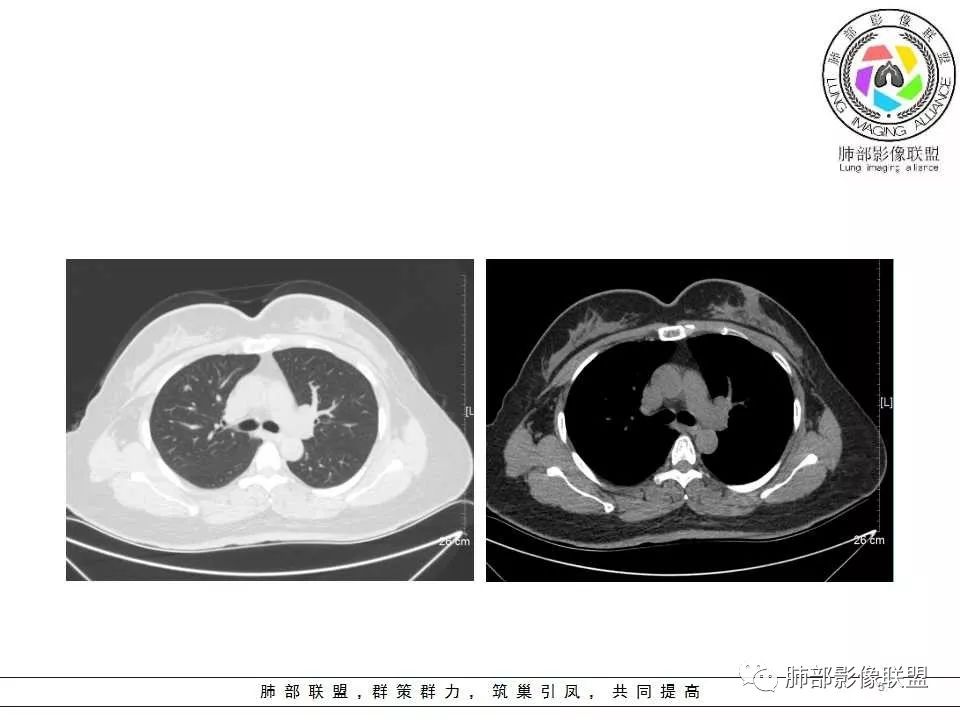 影像PPT - 【病例】肺隐球菌病1例CT影像-5 影像PPT - 【病例】肺隐球菌病1例CT影像-5