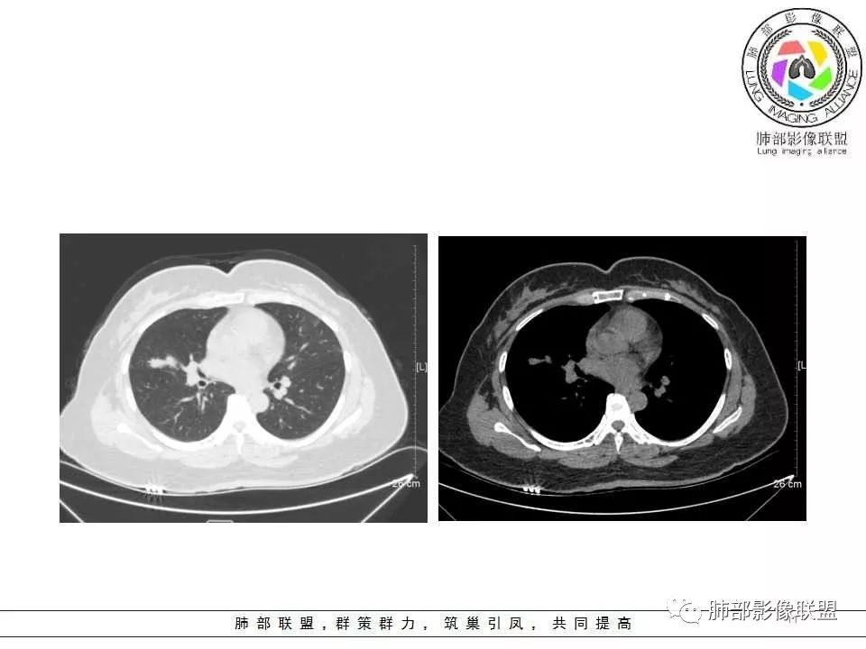 影像PPT - 【病例】肺隐球菌病1例CT影像-11 影像PPT - 【病例】肺隐球菌病1例CT影像-11
