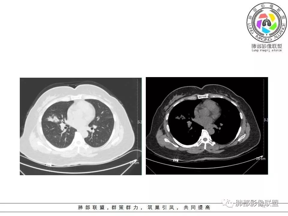 影像PPT - 【病例】肺隐球菌病1例CT影像-12 影像PPT - 【病例】肺隐球菌病1例CT影像-12
