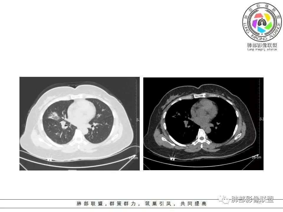 影像PPT - 【病例】肺隐球菌病1例CT影像-13 影像PPT - 【病例】肺隐球菌病1例CT影像-13