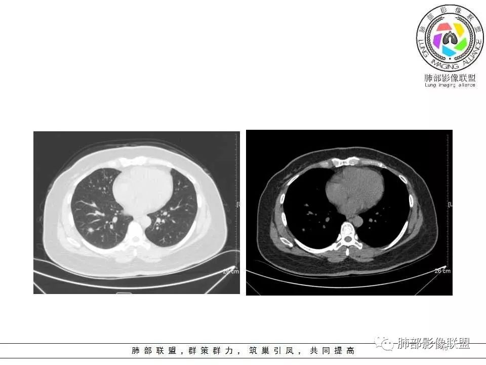 影像PPT - 【病例】肺隐球菌病1例CT影像-15 影像PPT - 【病例】肺隐球菌病1例CT影像-15