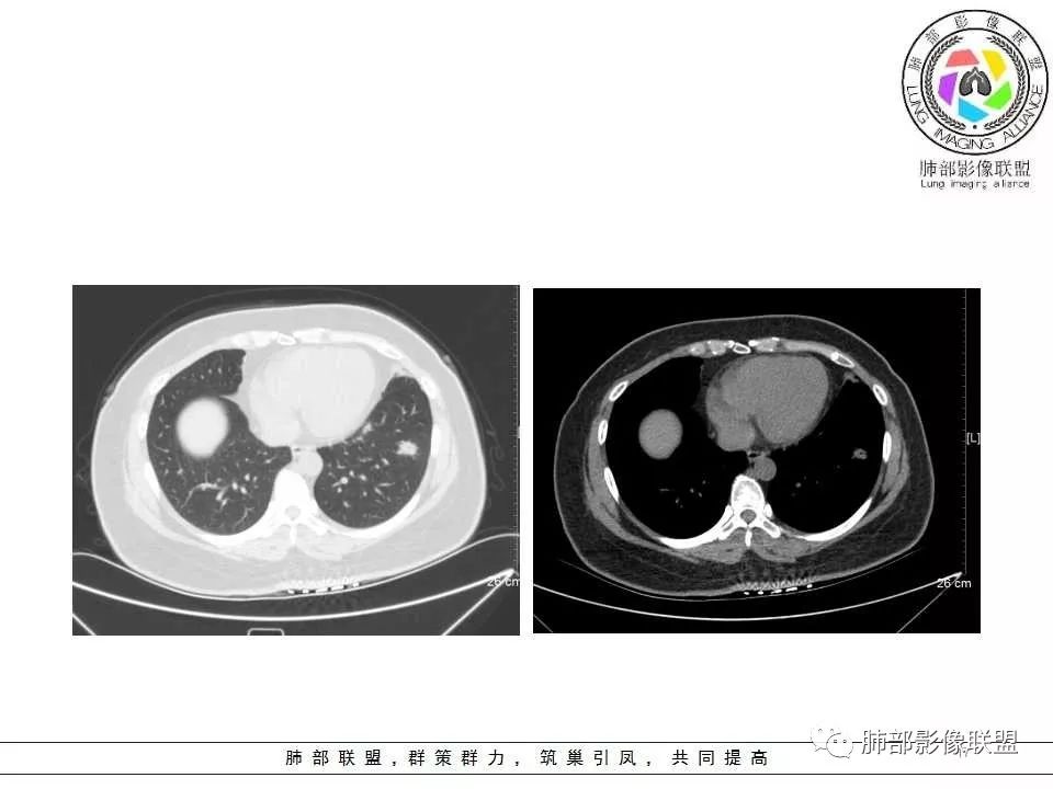 影像PPT - 【病例】肺隐球菌病1例CT影像-17 影像PPT - 【病例】肺隐球菌病1例CT影像-17