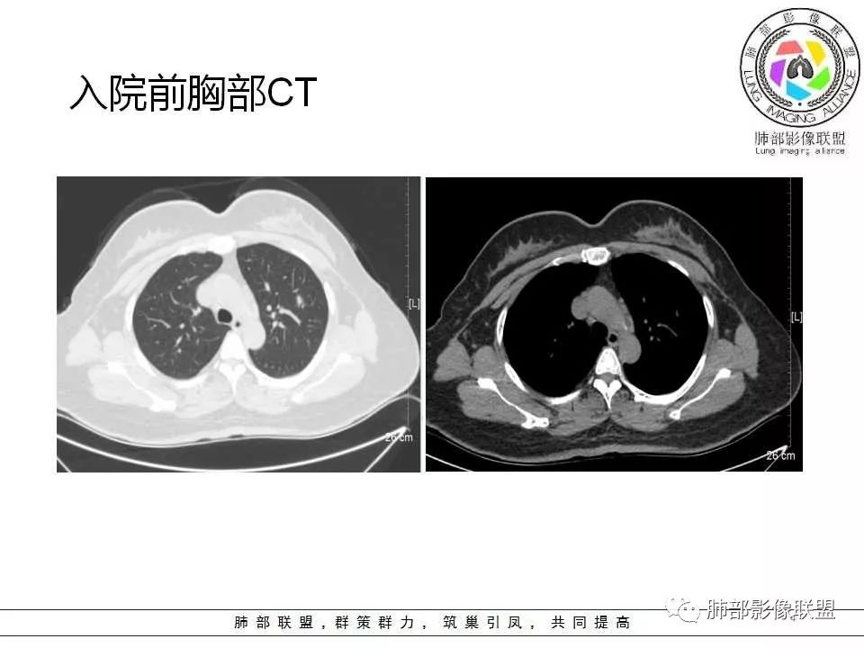 影像PPT - 【病例】肺隐球菌病1例CT影像-4 影像PPT - 【病例】肺隐球菌病1例CT影像-4
