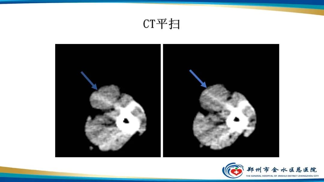 影像PPT - 【病例】软组织淋巴瘤1例X线CT及MR影像-4