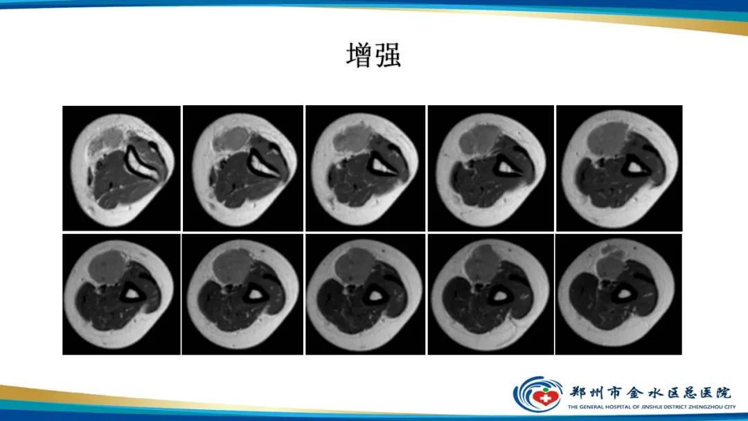 影像PPT - 【病例】软组织淋巴瘤1例X线CT及MR影像-8