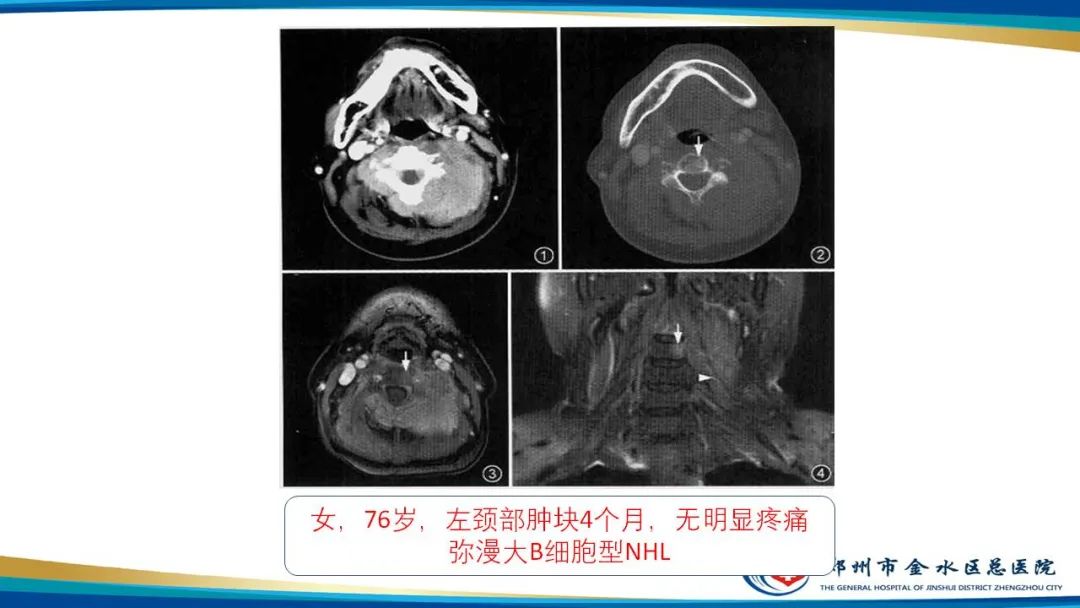 影像PPT - 【病例】软组织淋巴瘤1例X线CT及MR影像-20
