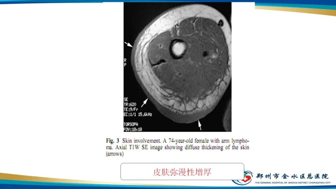 影像PPT - 【病例】软组织淋巴瘤1例X线CT及MR影像-23