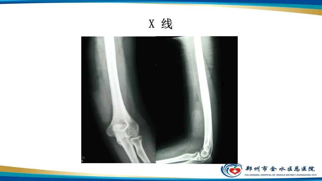 影像PPT - 【病例】软组织淋巴瘤1例X线CT及MR影像-3