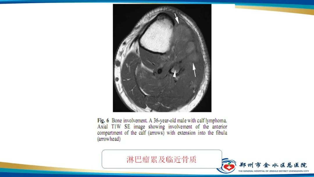 影像PPT - 【病例】软组织淋巴瘤1例X线CT及MR影像-26