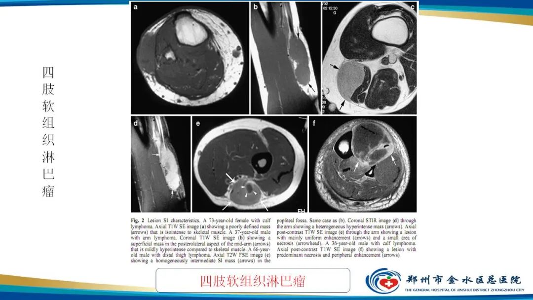 影像PPT - 【病例】软组织淋巴瘤1例X线CT及MR影像-22