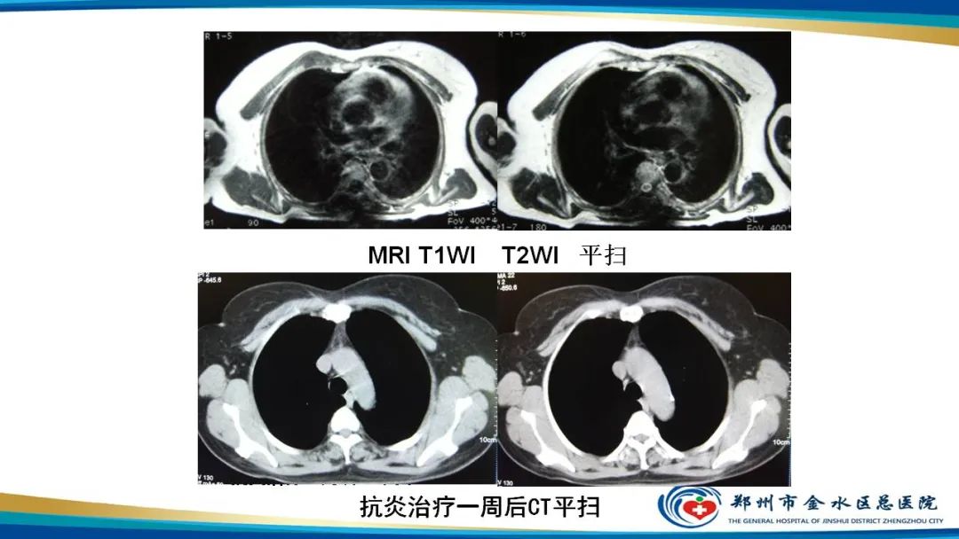 影像PPT - 【病例】软组织淋巴瘤1例X线CT及MR影像-29