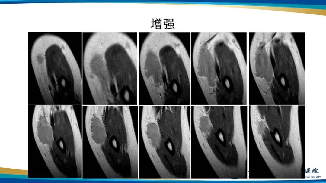 影像PPT - 【病例】软组织淋巴瘤1例X线CT及MR影像-7