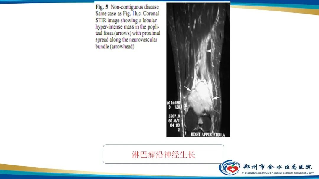 影像PPT - 【病例】软组织淋巴瘤1例X线CT及MR影像-25