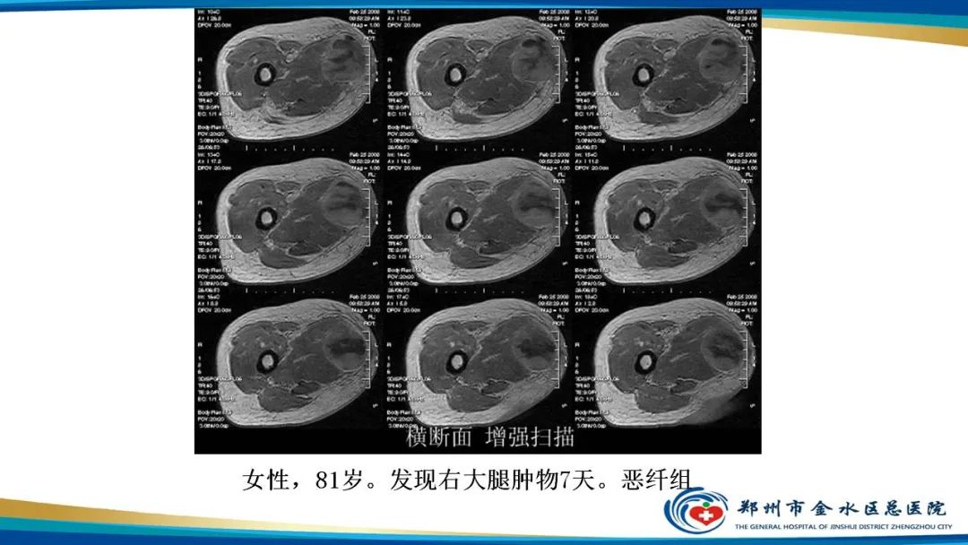 影像PPT - 【病例】软组织淋巴瘤1例X线CT及MR影像-33