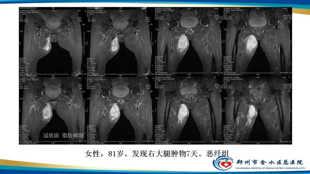 影像PPT - 【病例】软组织淋巴瘤1例X线CT及MR影像-32