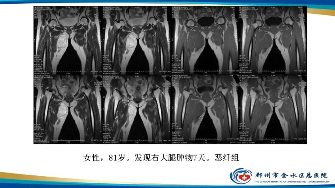 影像PPT - 【病例】软组织淋巴瘤1例X线CT及MR影像-31