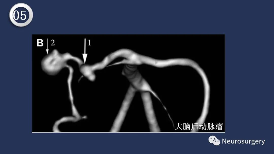 影像PPT - 【PPT】颅内动脉系统相关解剖-69