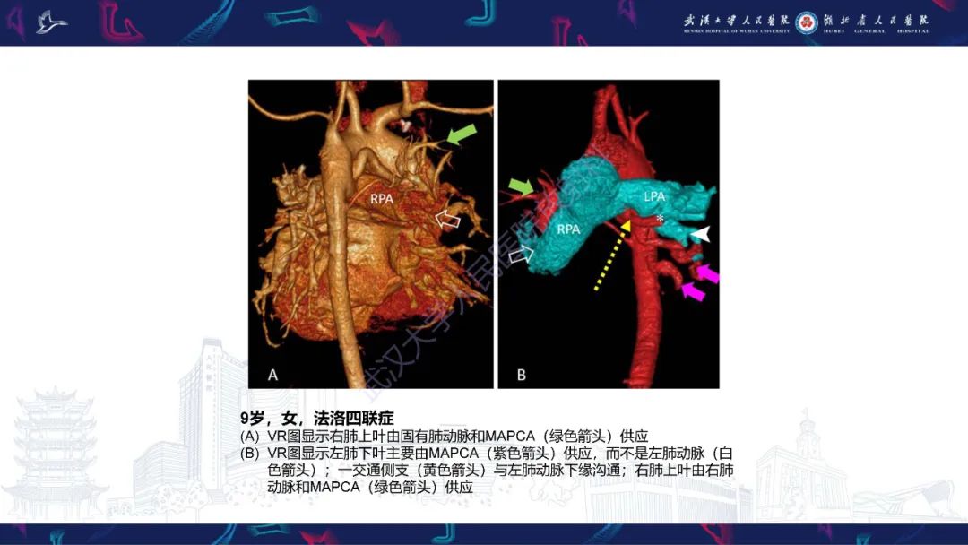 影像PPT - 【PPT】主肺动脉侧支影像诊断-8