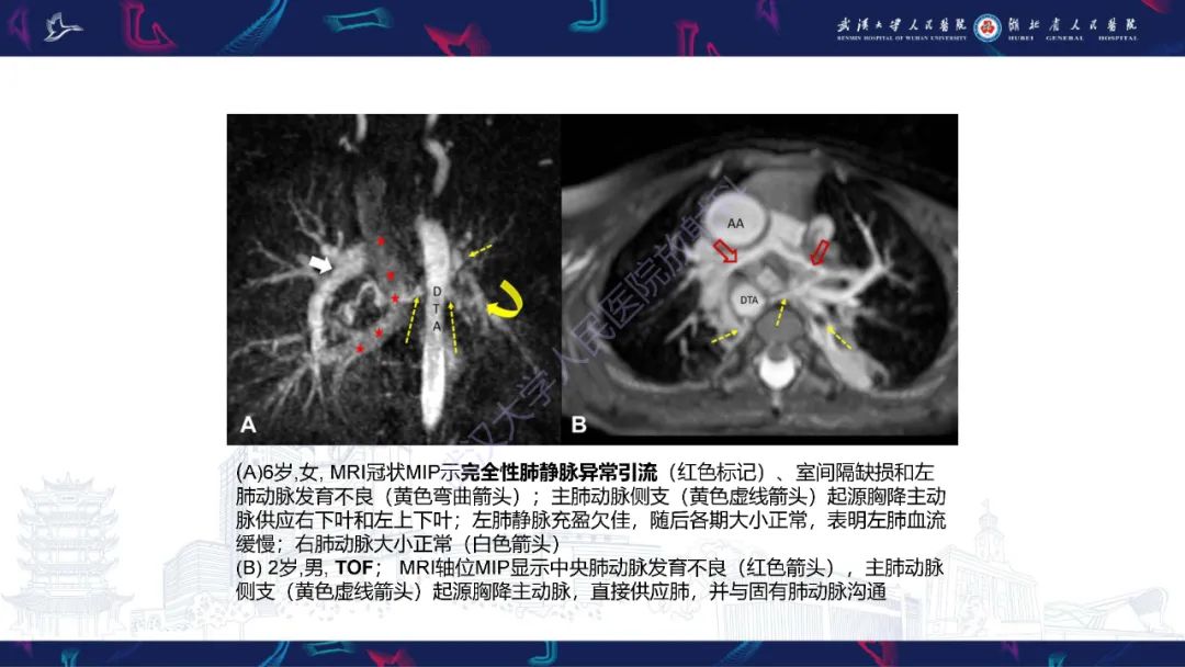 影像PPT - 【PPT】主肺动脉侧支影像诊断-16