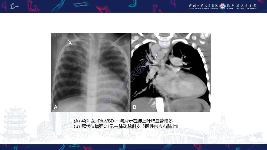 影像PPT - 【PPT】主肺动脉侧支影像诊断-14